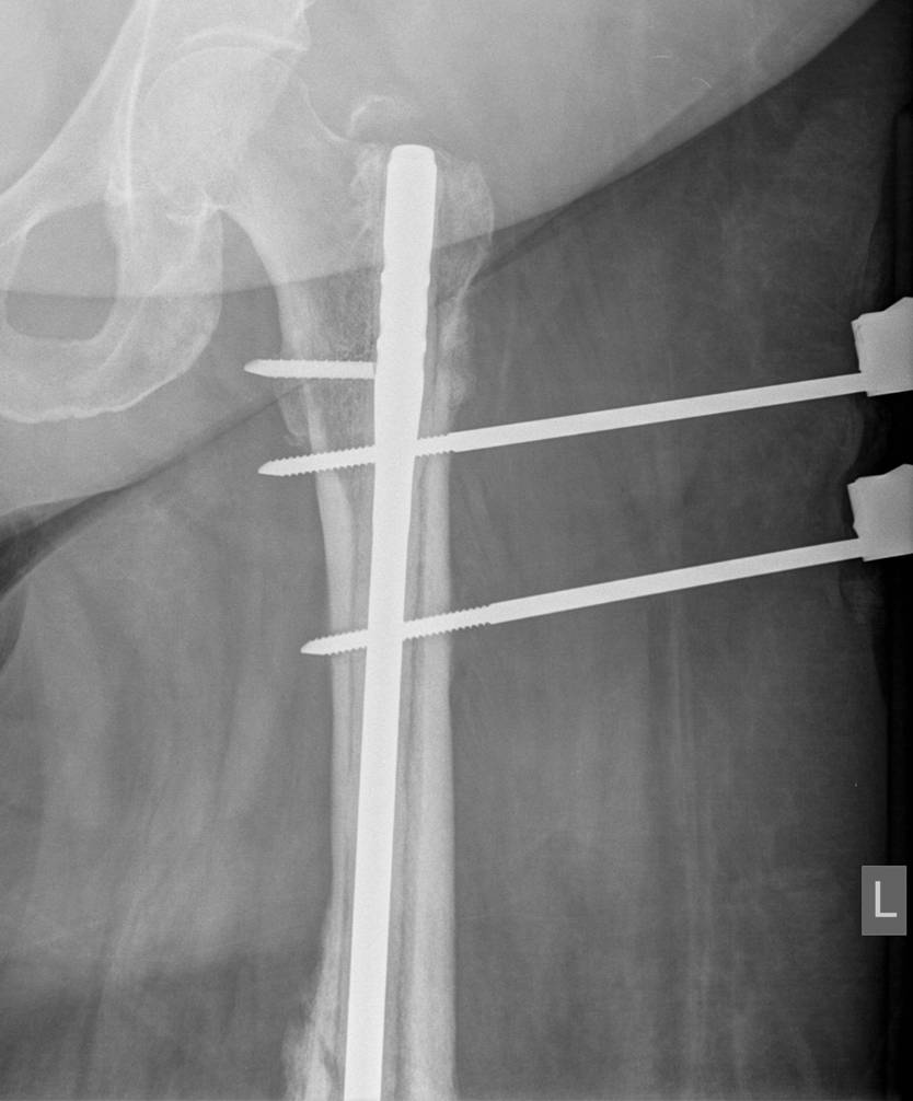 Infected Femoral Nail2